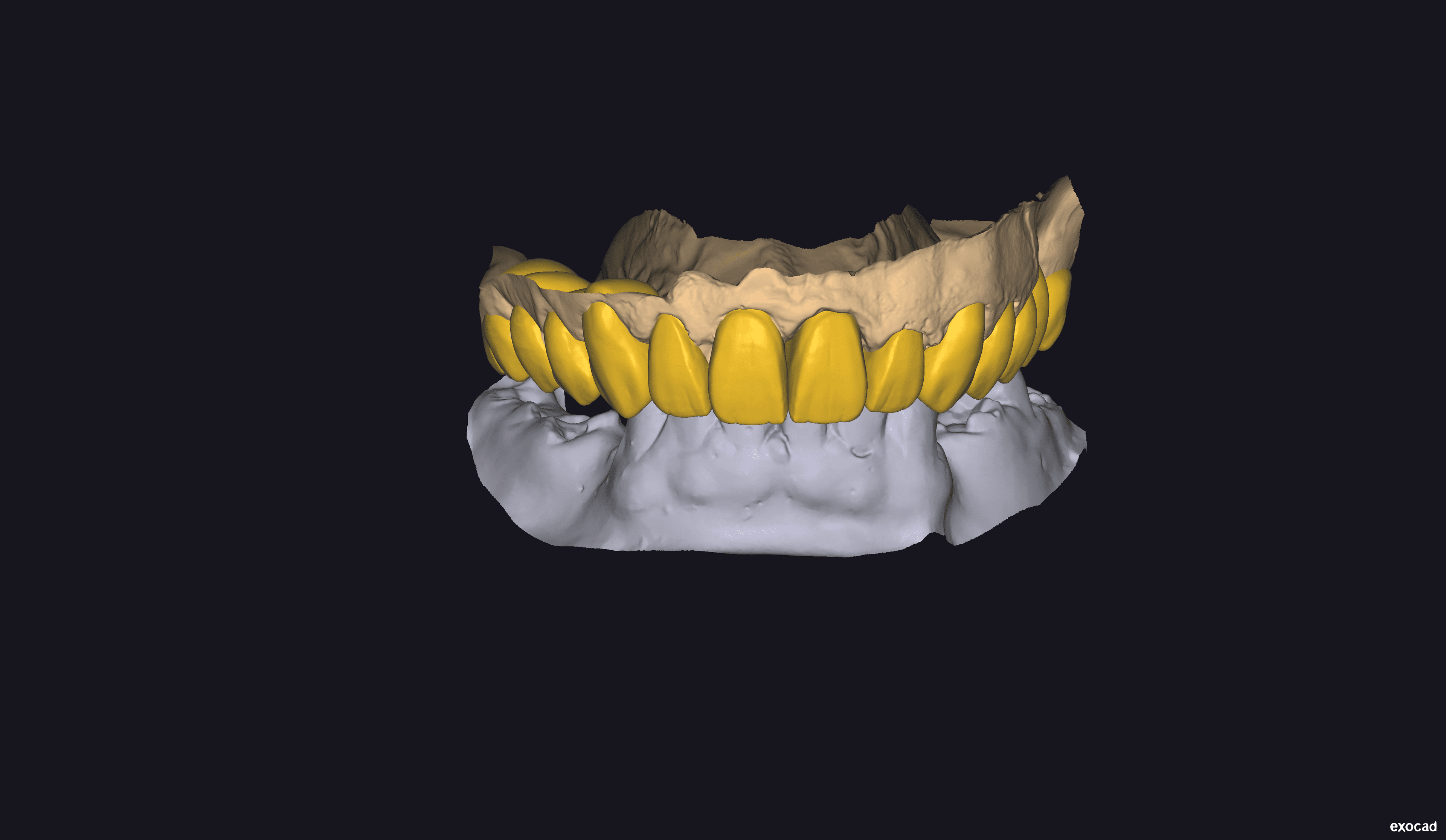 Initial design of the diagnostic wax-up