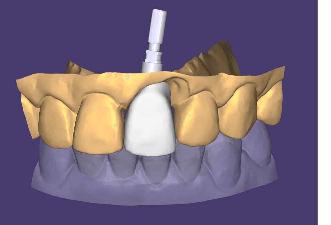 STL File of the tooth structure