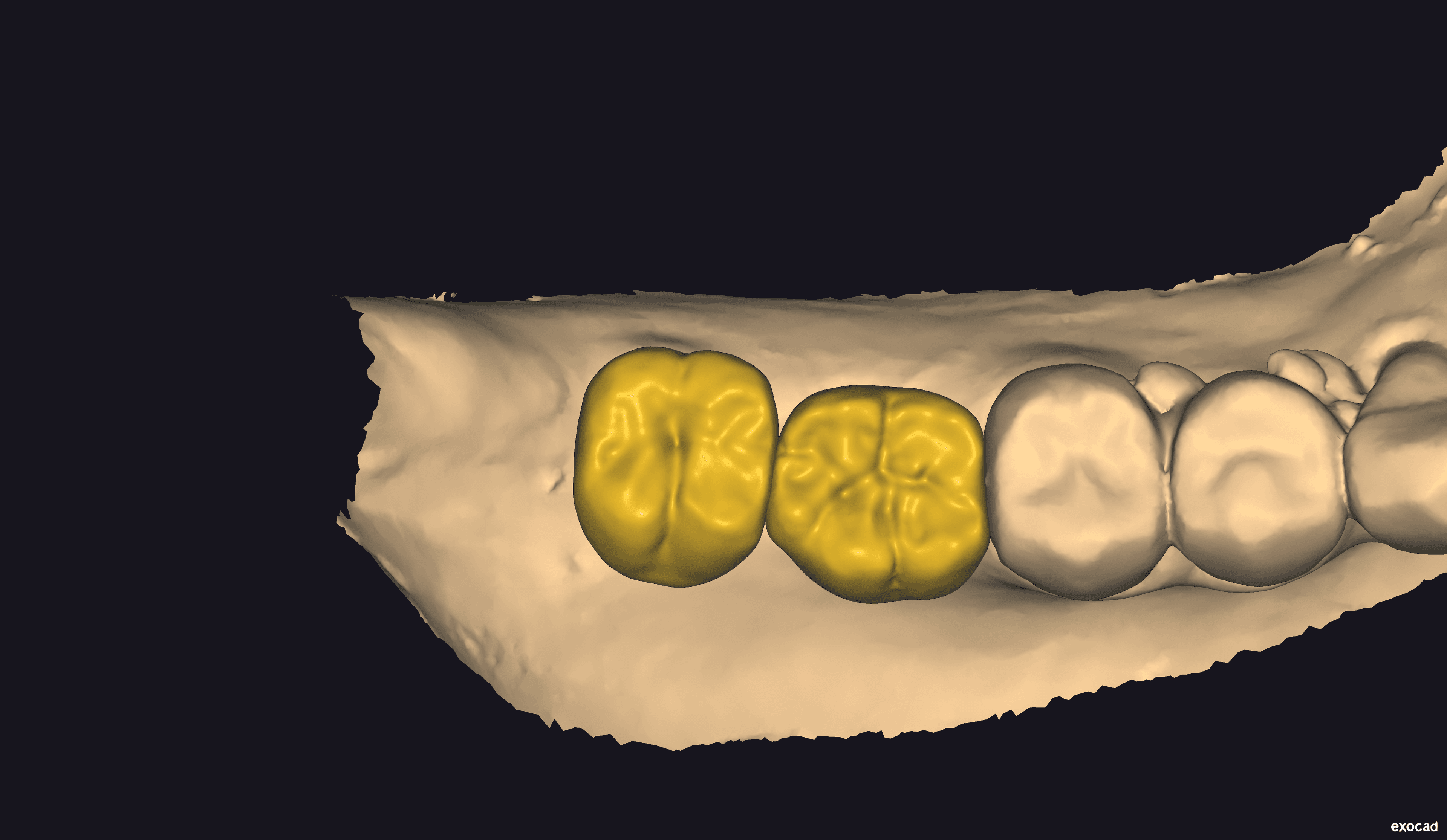 Initial diagnostic wax-up planning - View 1