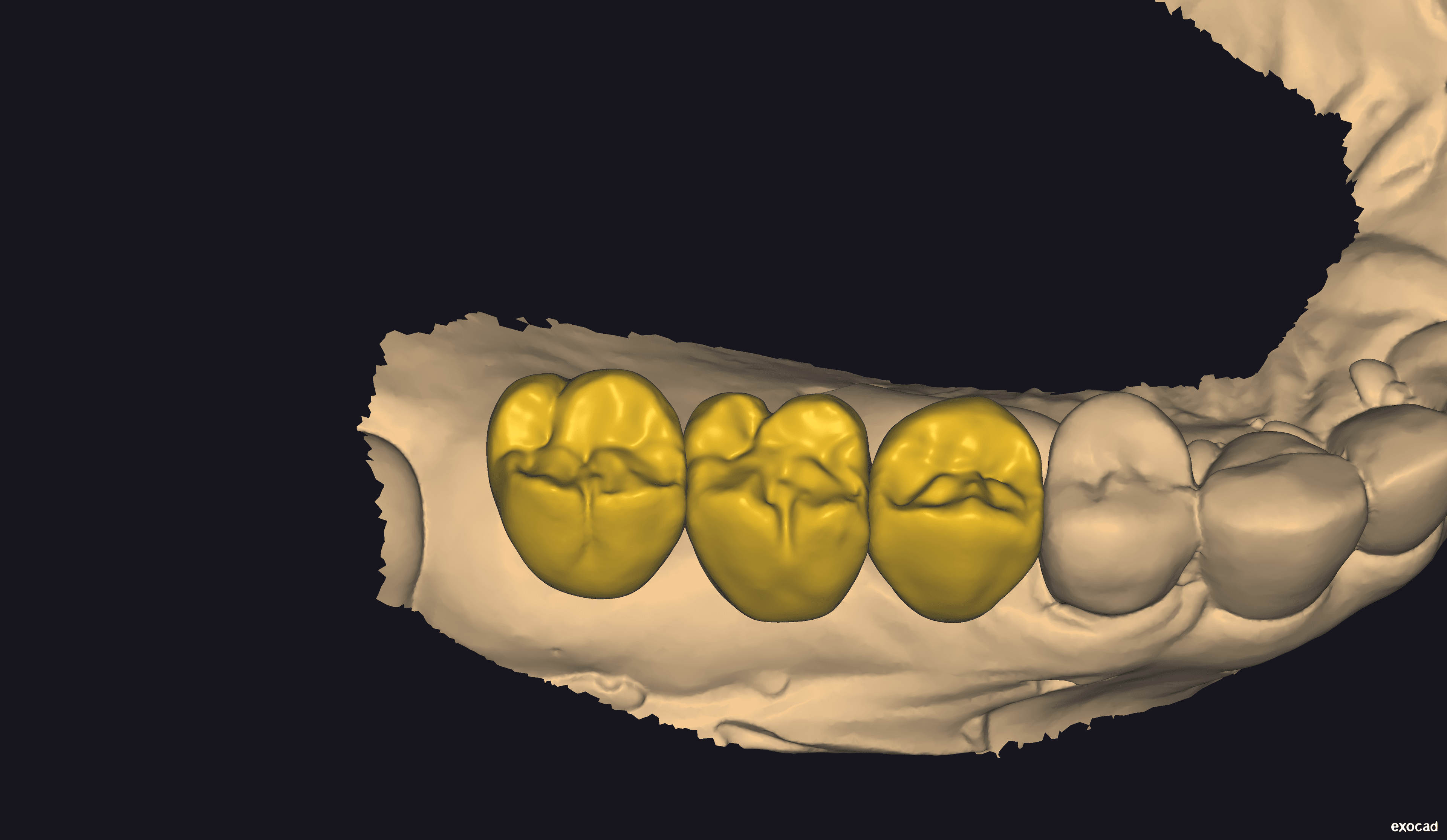 Initial diagnostic wax-up planning - View 2