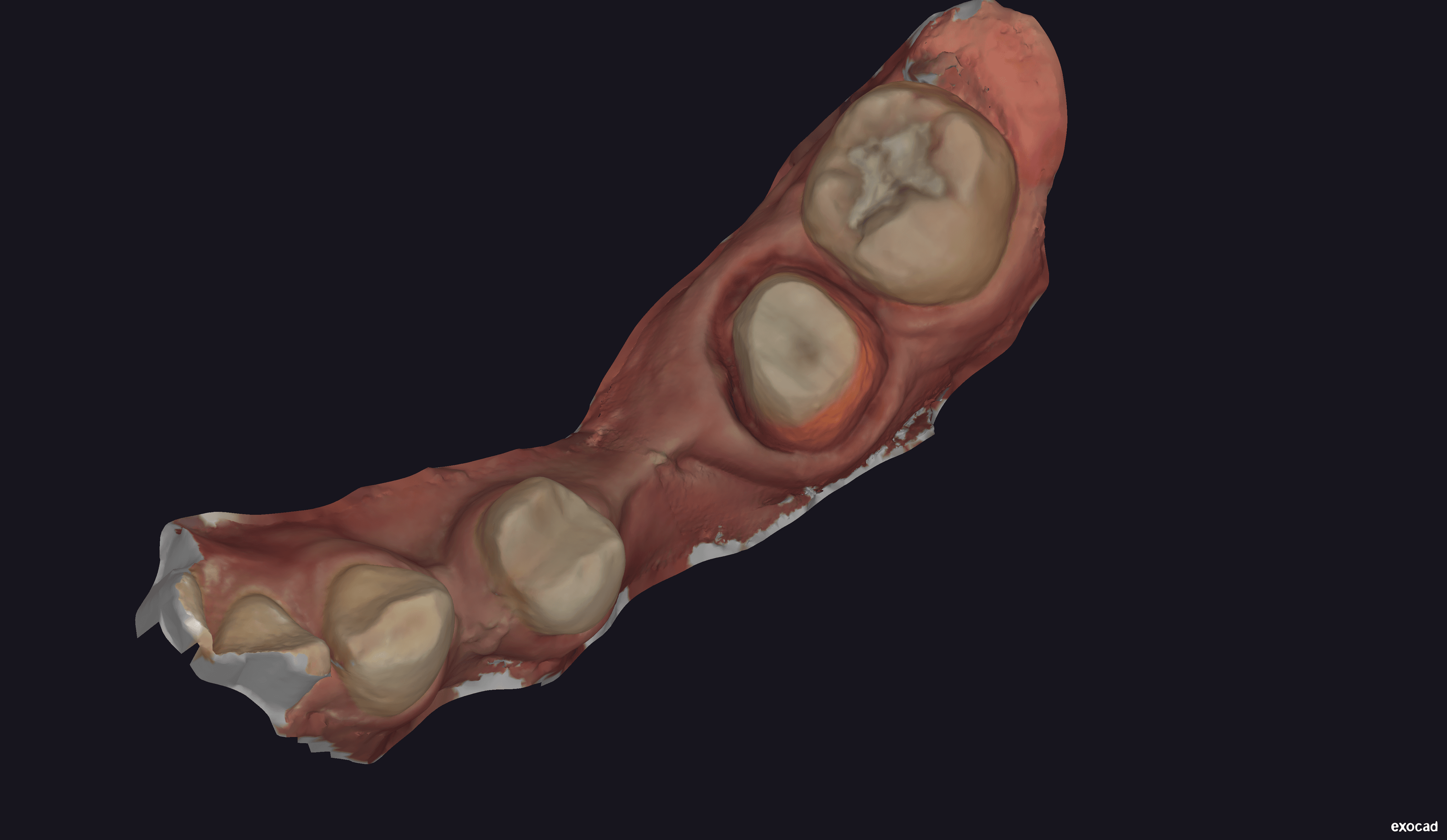 Initial Itero scan - View 2