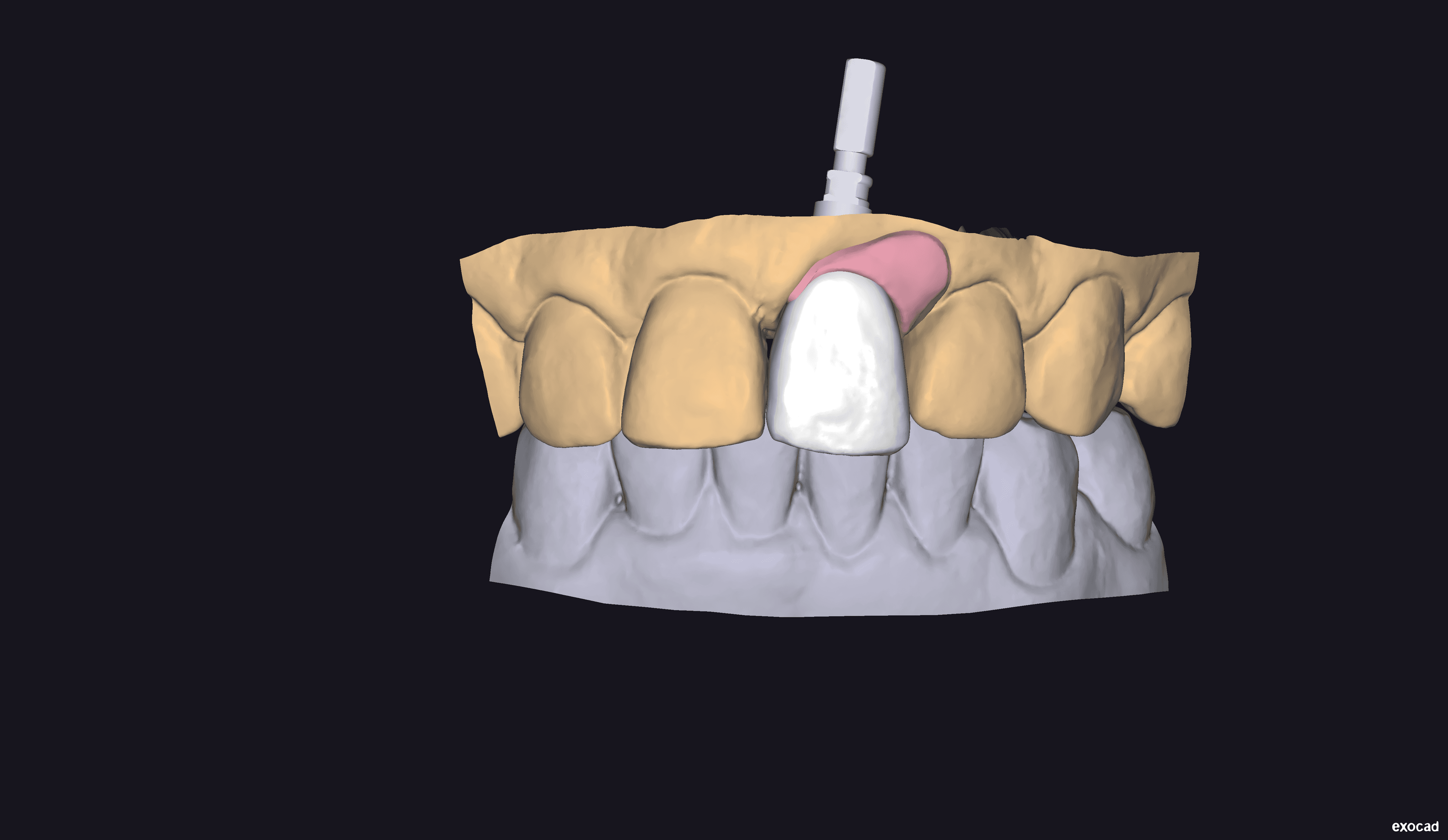 Tissue design showing gingival contour preservation