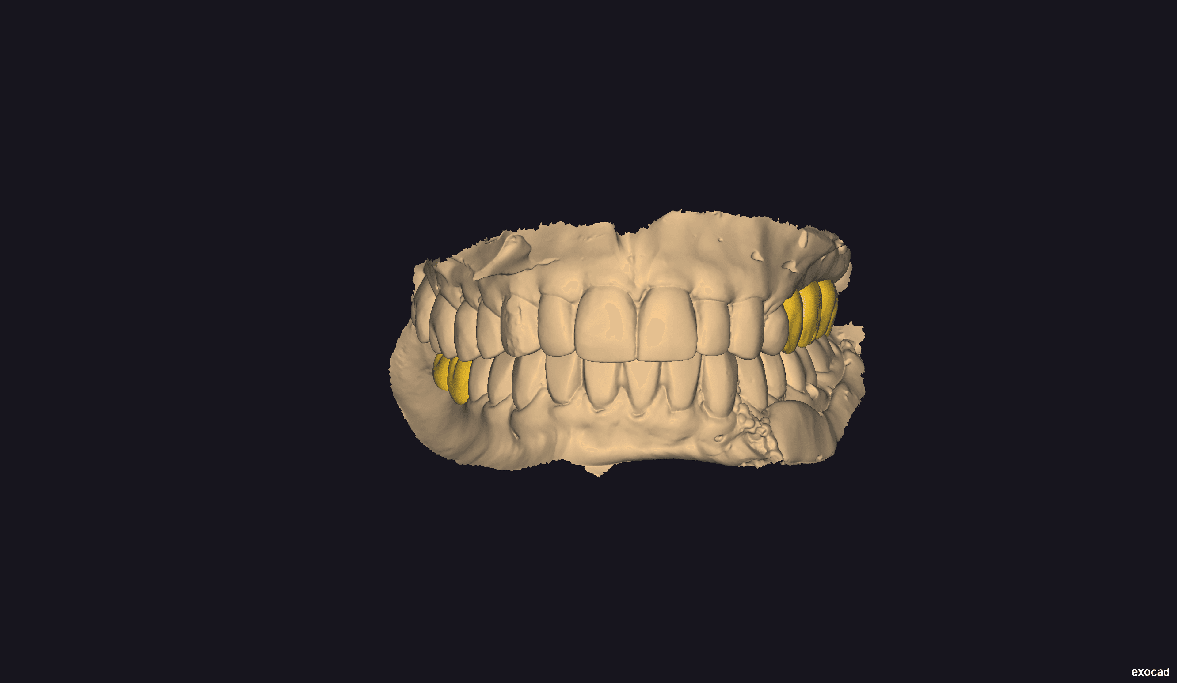 Development of provisional crowns in Exocad