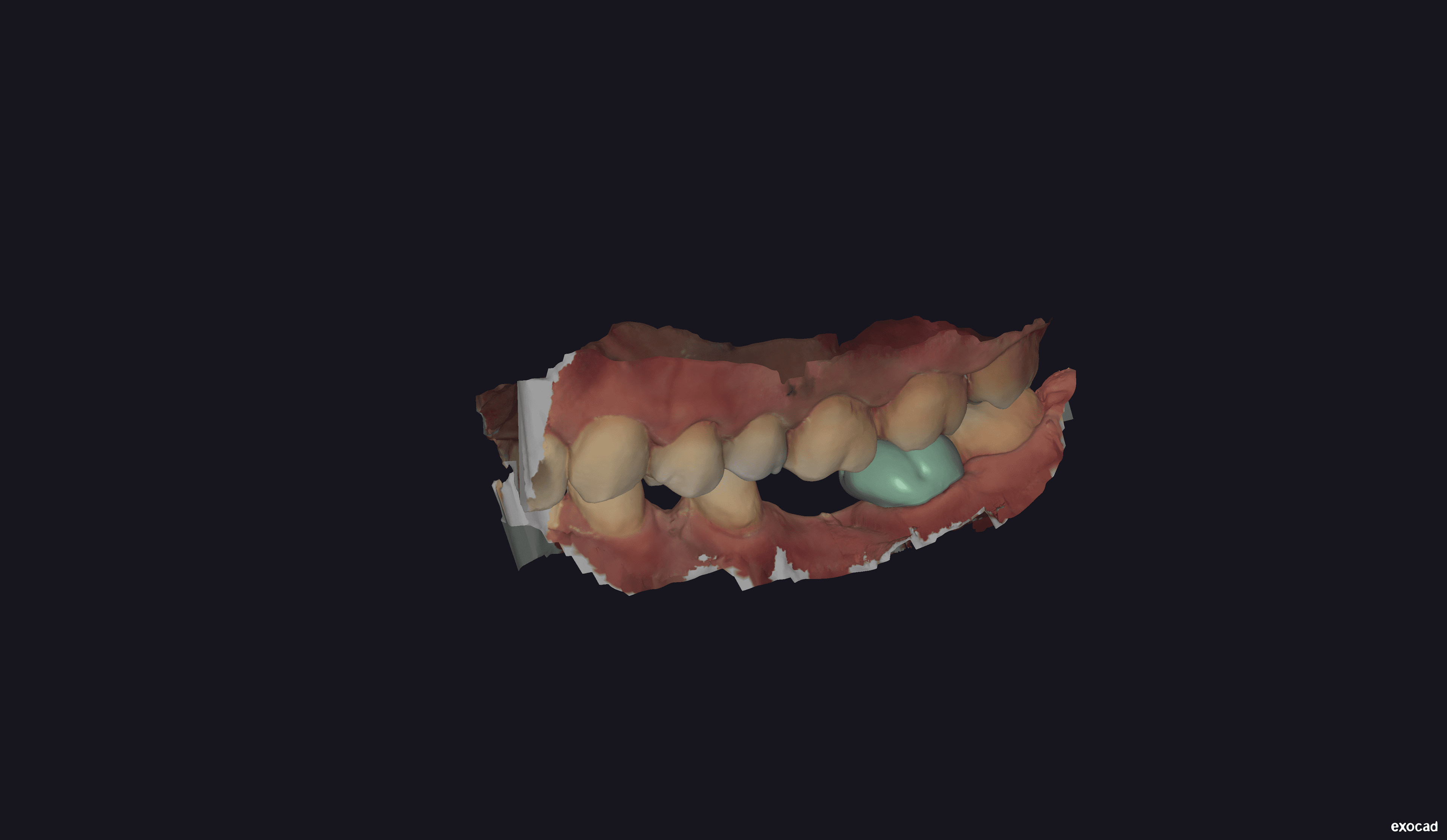 Development of unitary crown for element 36 in Exocad