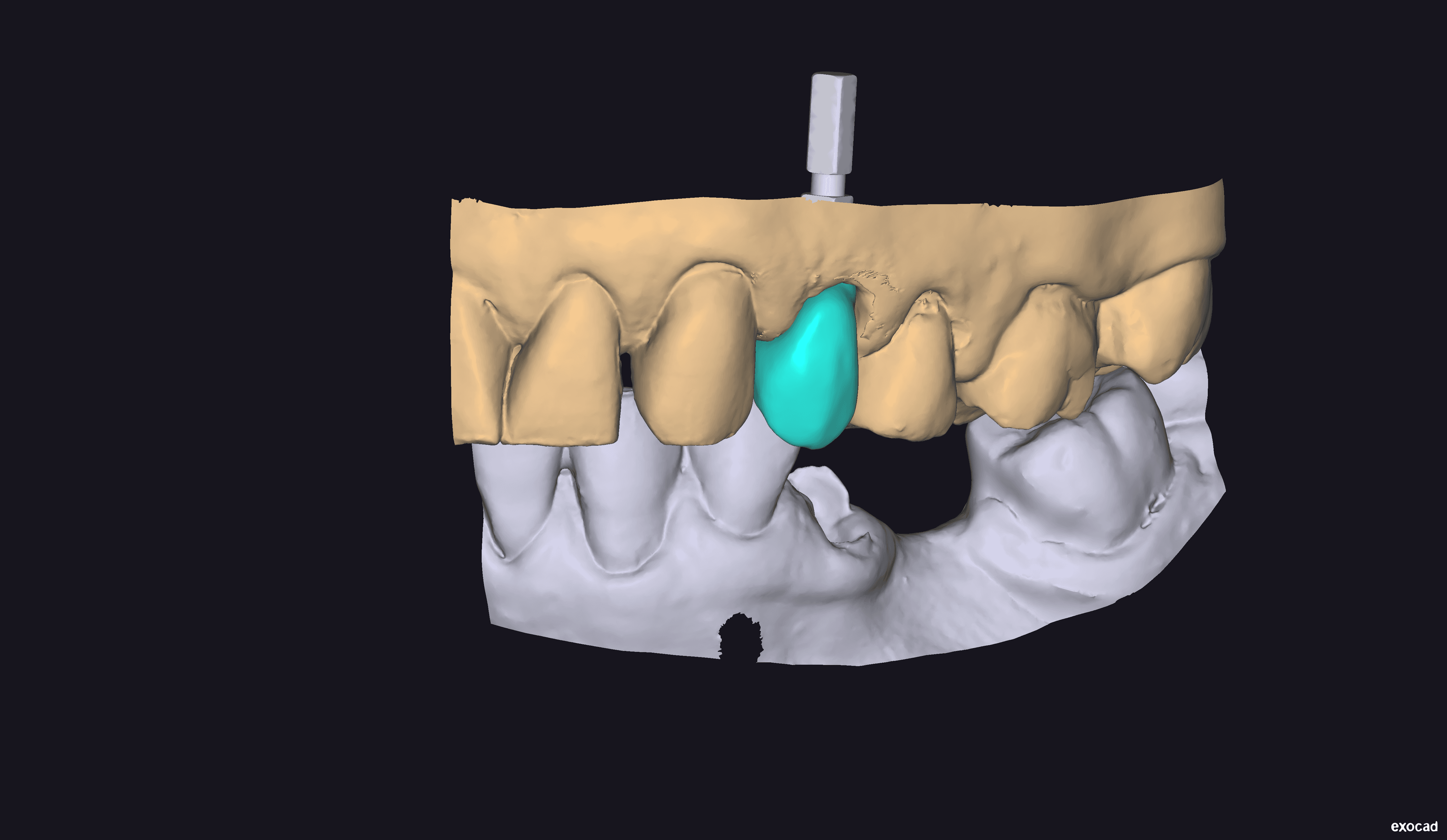 Second scan showing improved gingival condition and implant positioning