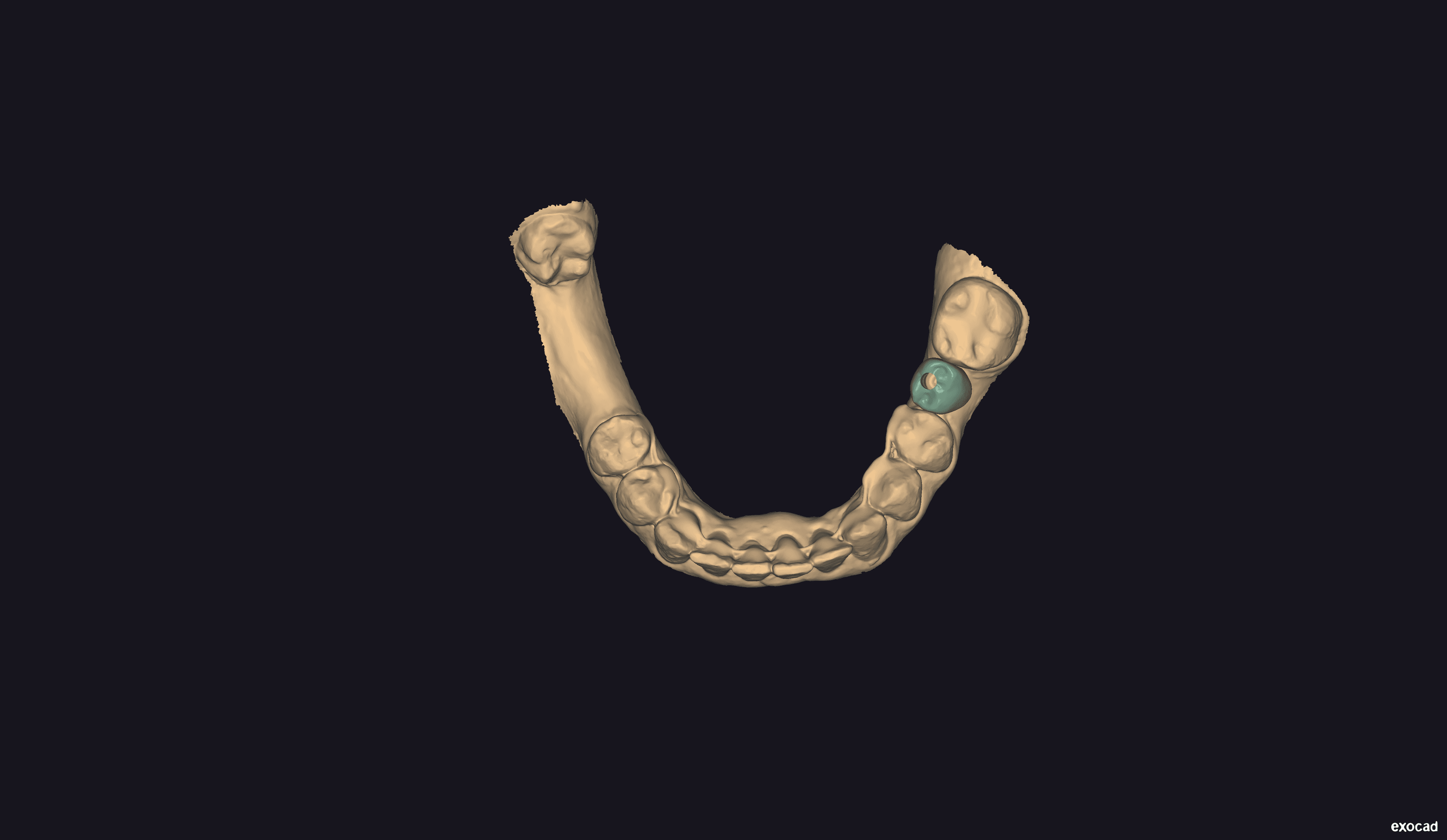 Lower crowns design for 24 and 36