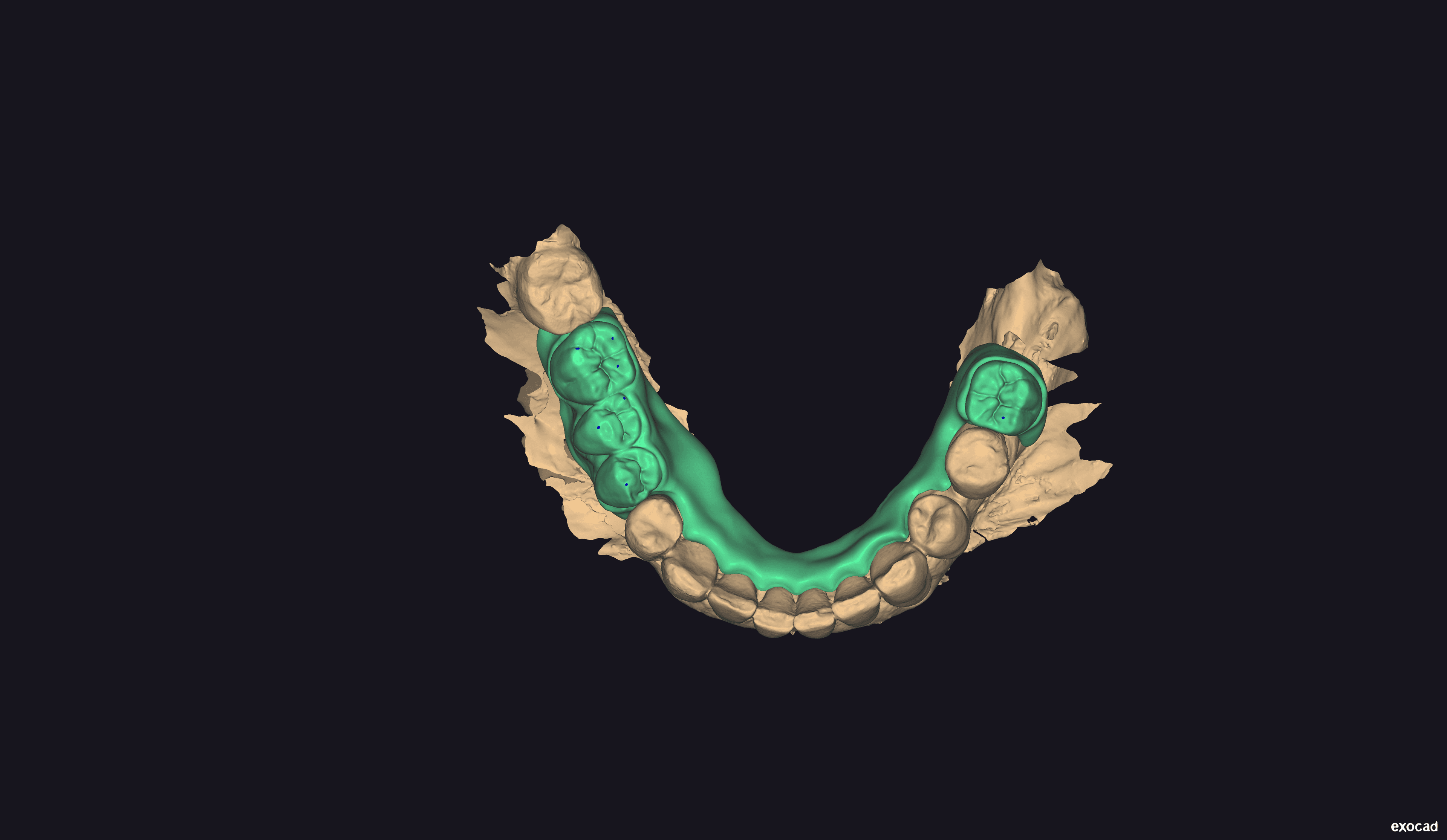 Lower prosthesis
