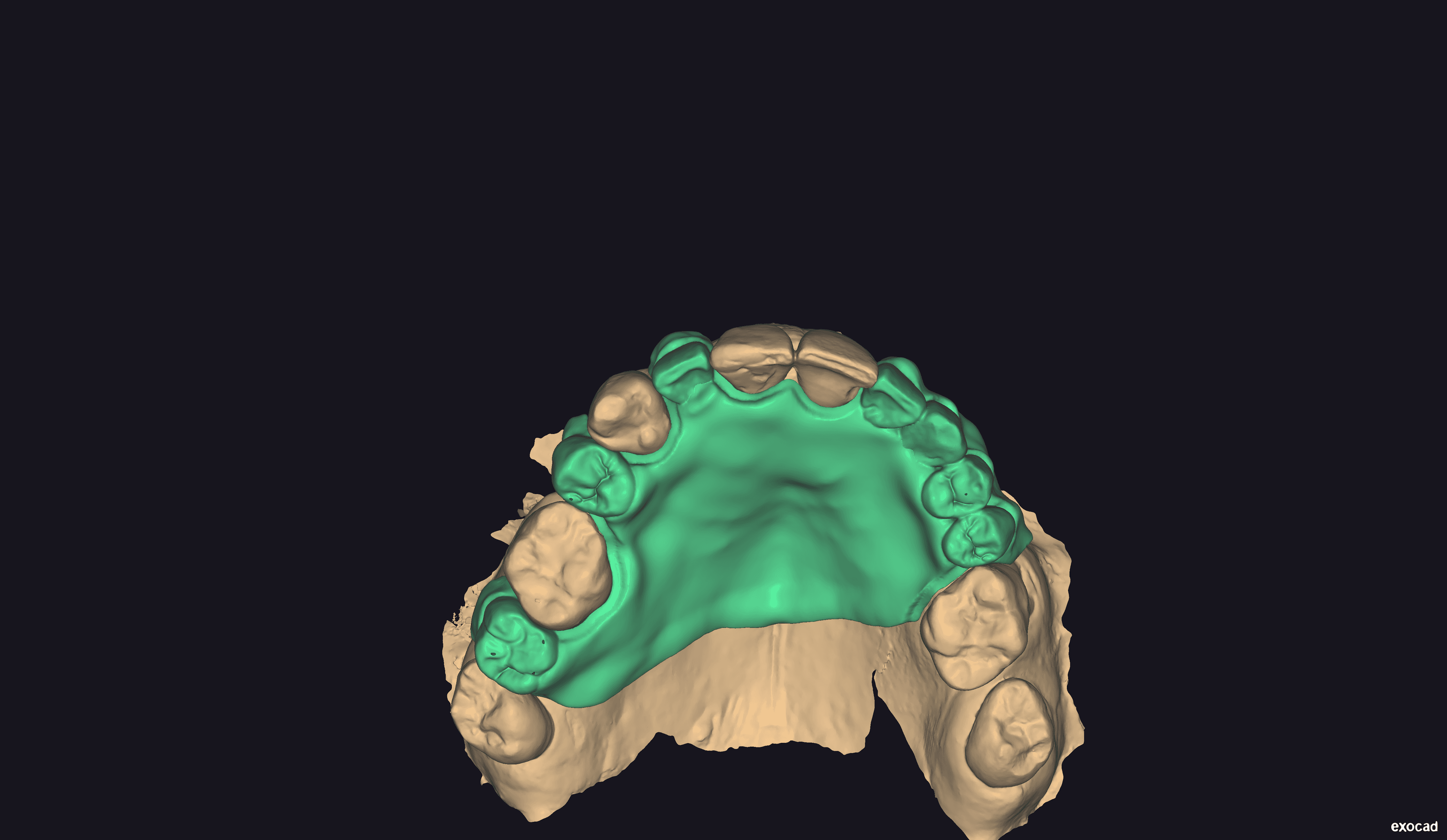 Upper prosthesis