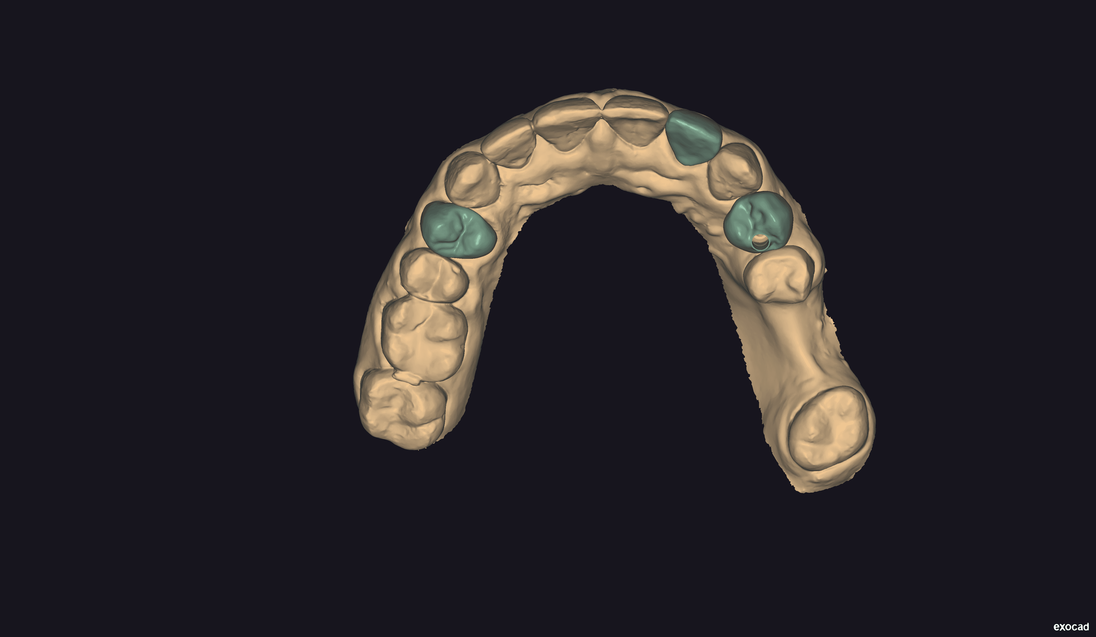 Upper crowns design for 14 and 22