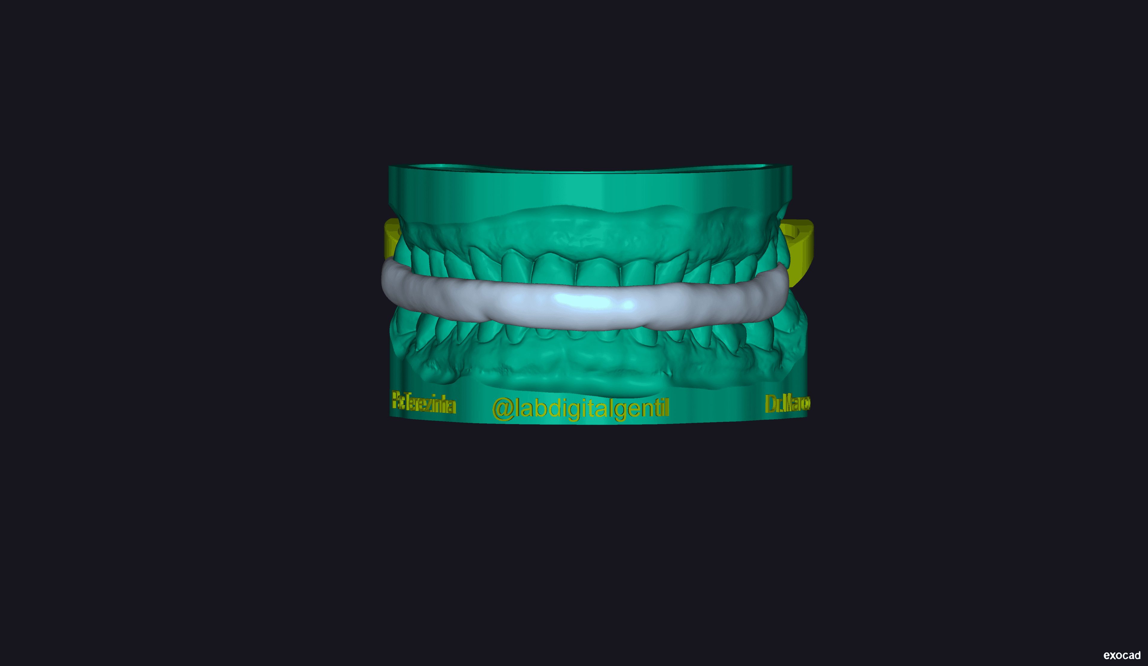 Final 3D Model of Bite Splint