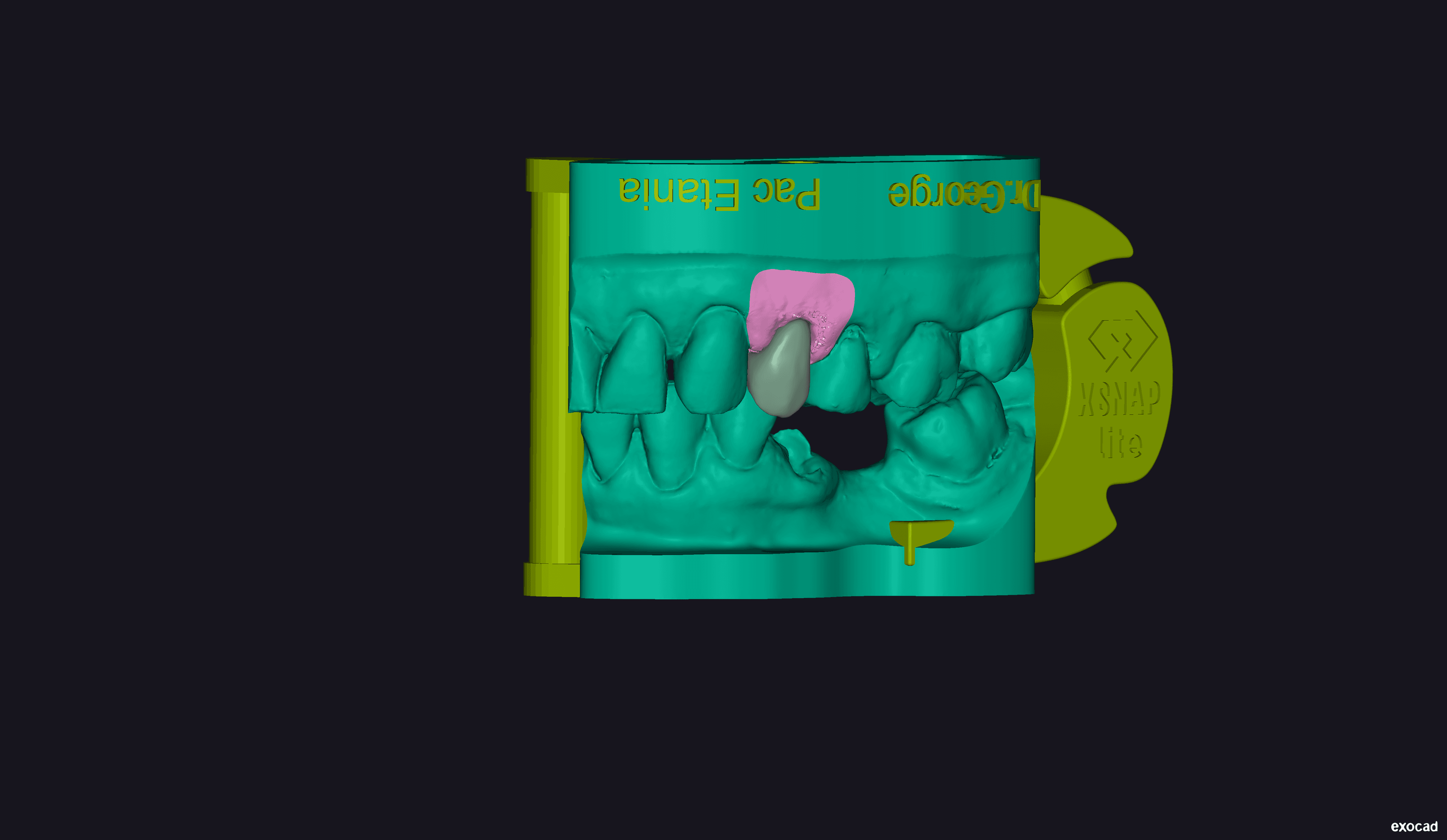 Cemented crown in patient's mouth showing final restoration