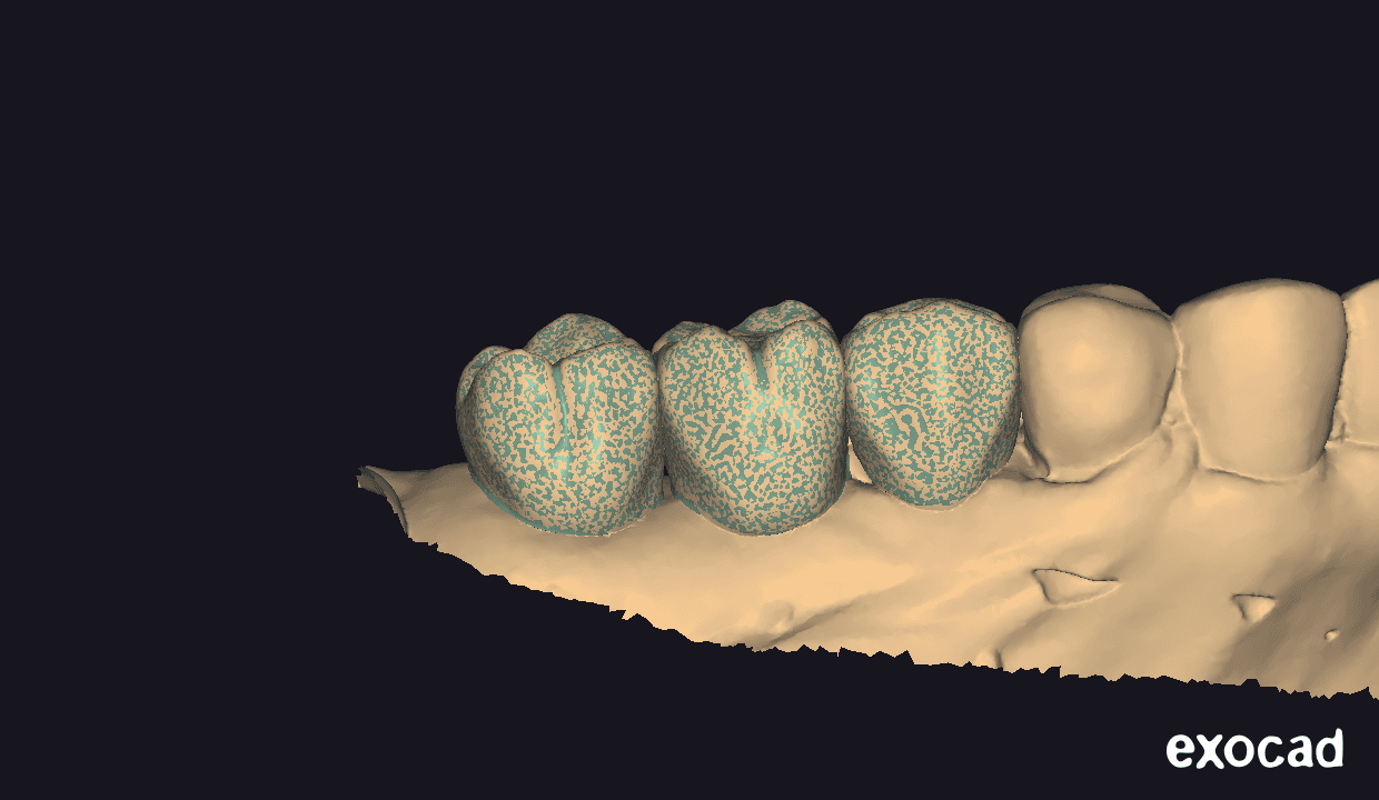 Final model of provisional crowns - View 1
