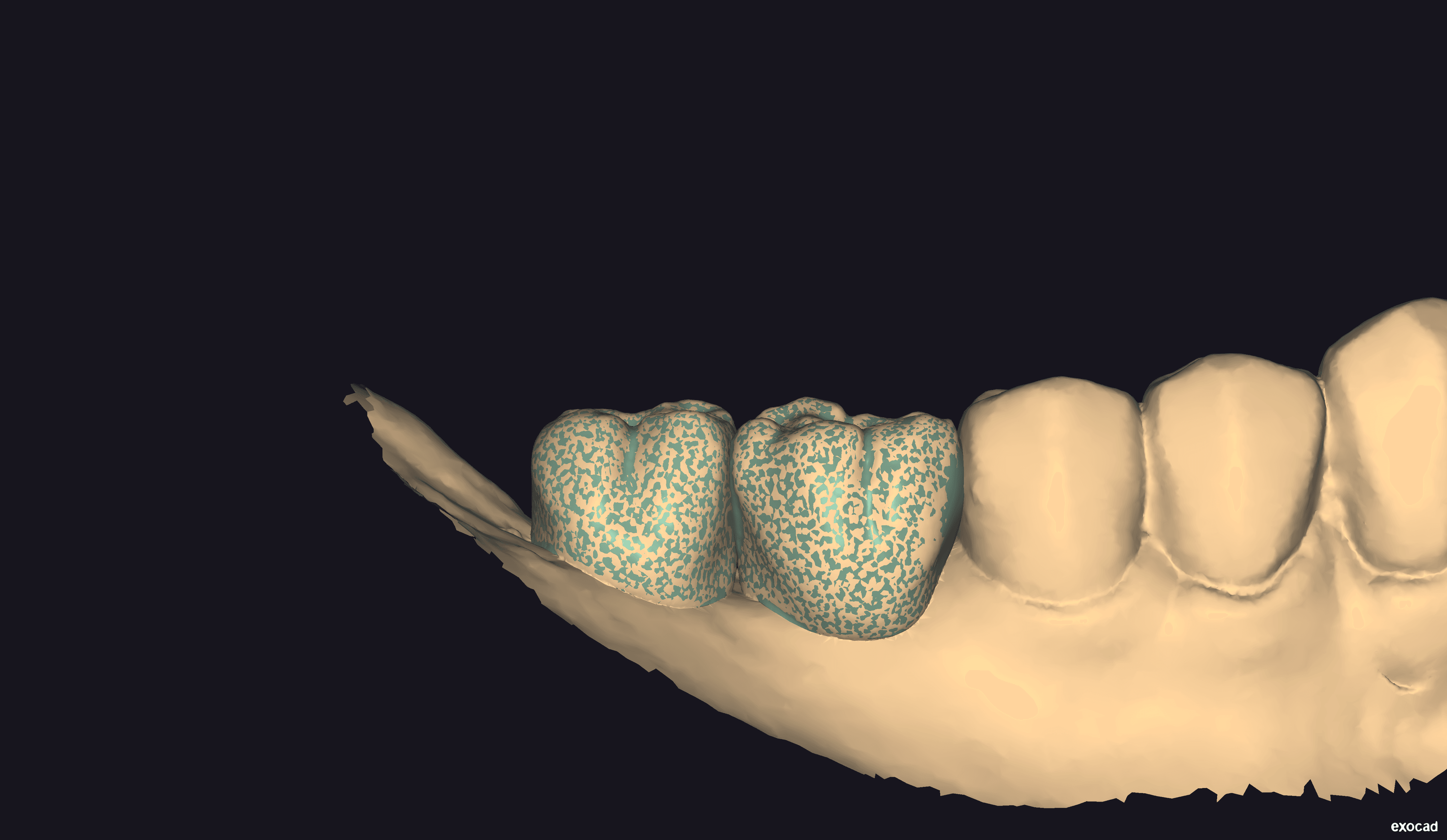 Final model of provisional crowns - View 2