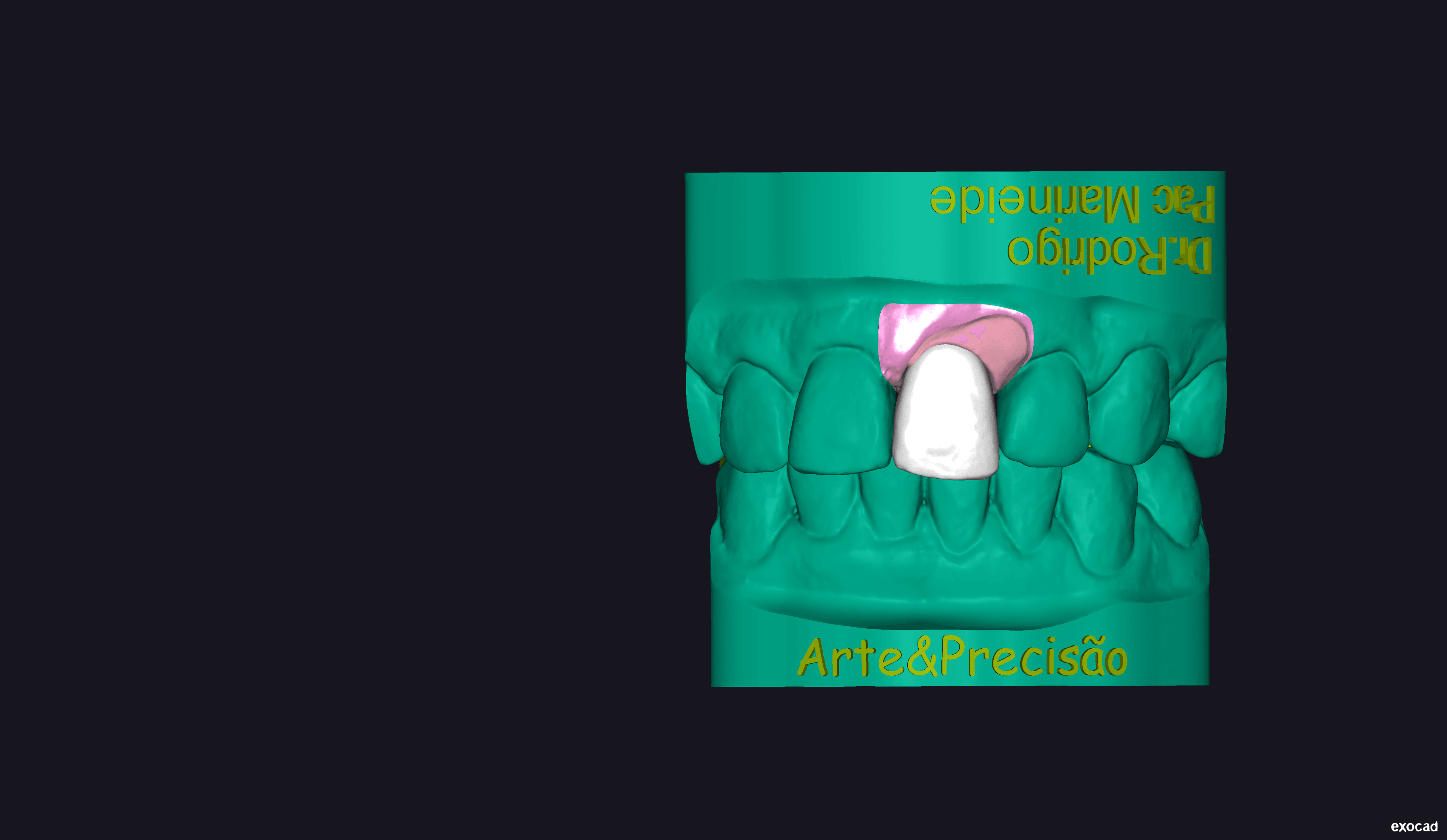 Final 3D model of the crown and abutment